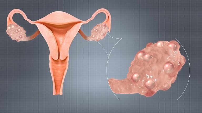 PCOS Treatment