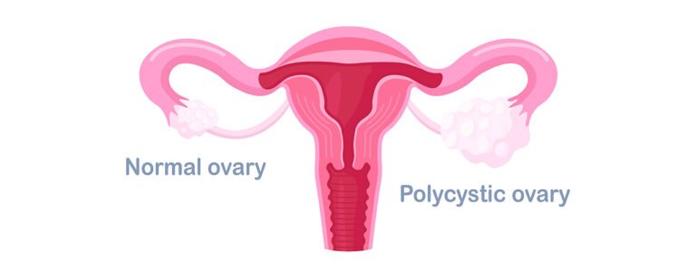 PCOS: Unmasking The Mystery Of The Misunderstood Ovaries